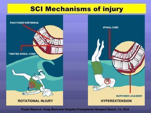 Graphic of spinal cord injury diving into shallow water